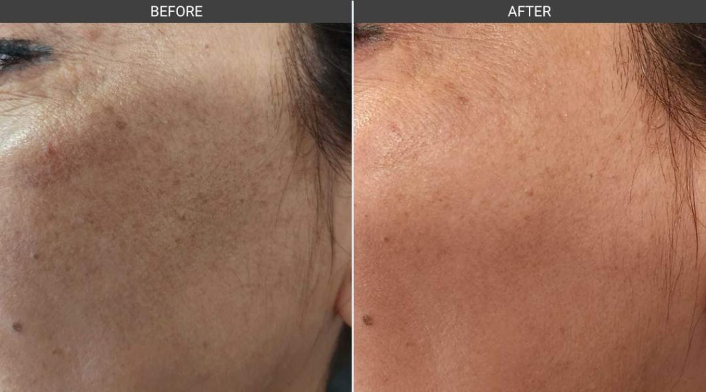 Before and After Microneedling