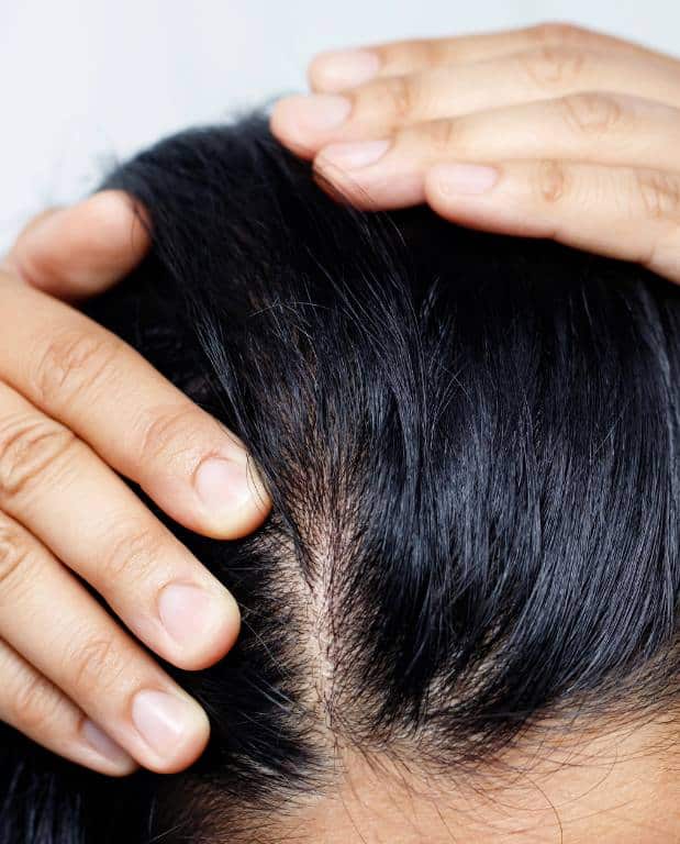 PRP and PRF Injections for hair loss.