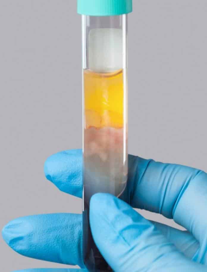 Tube used for PRF (Platelet-Rich Fibrin) treatments at Dermatouch.